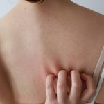 Eine Frau juckt sich am Rücken. Neurodermitis bei Erwachsenen.